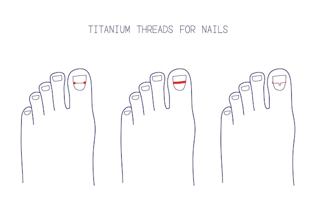 Treatment of ingrown toenail with titanium brackets different types Hand drawn vector illustration