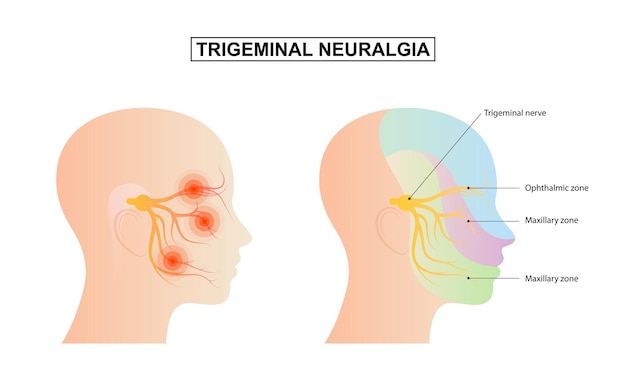 Vettore nevralgia del trigemino dolore cronico