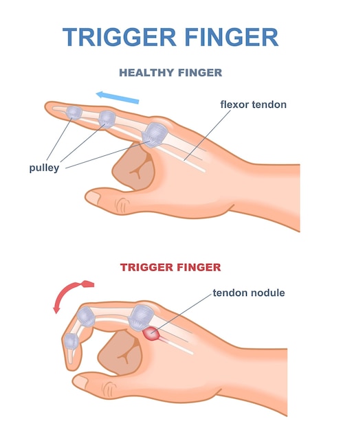 Triggerfinger diagram