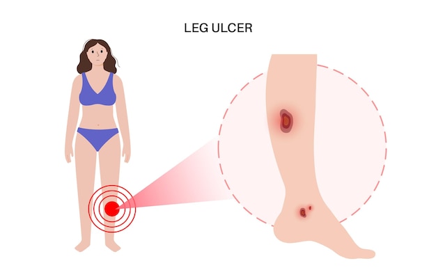 벡터 영양 궤양 해부학