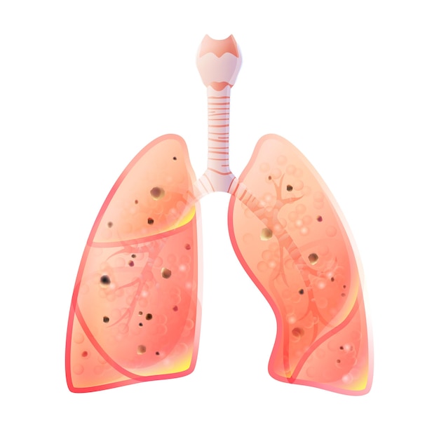 Vector tuberculosis. vector silhouette medical illustration of human body organ - lungs with trachea. poster for clinic, hospital. respiratory system.