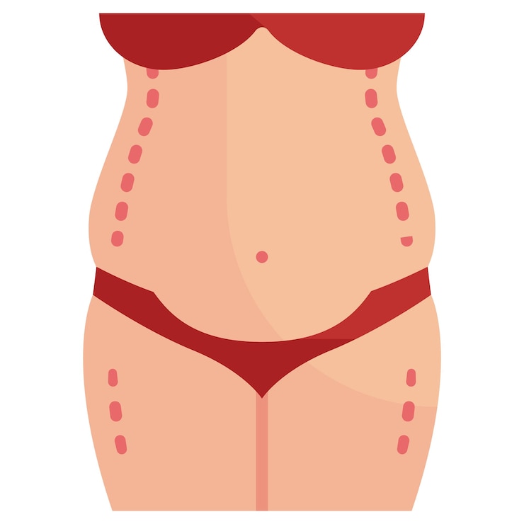 Вектор концепция операционной маркировки abdominoplasty нижней линии разреза нарисованной векторной иконы