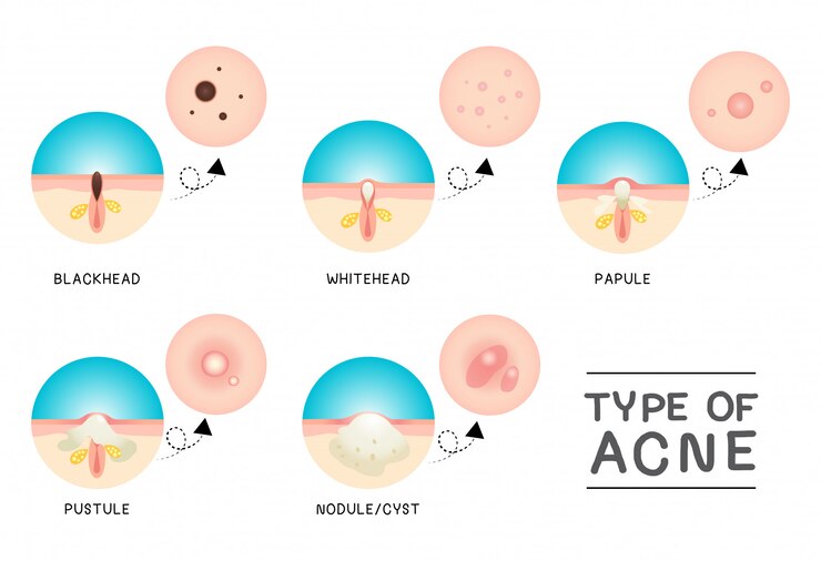 Type Acne
