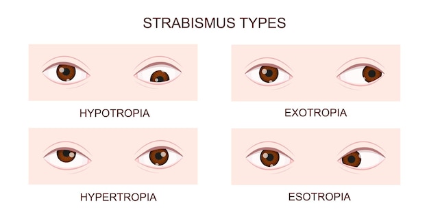 Vector typen scheelzien hypotropie hypertropie exotropie esotropie menselijke ogen met scheelzien