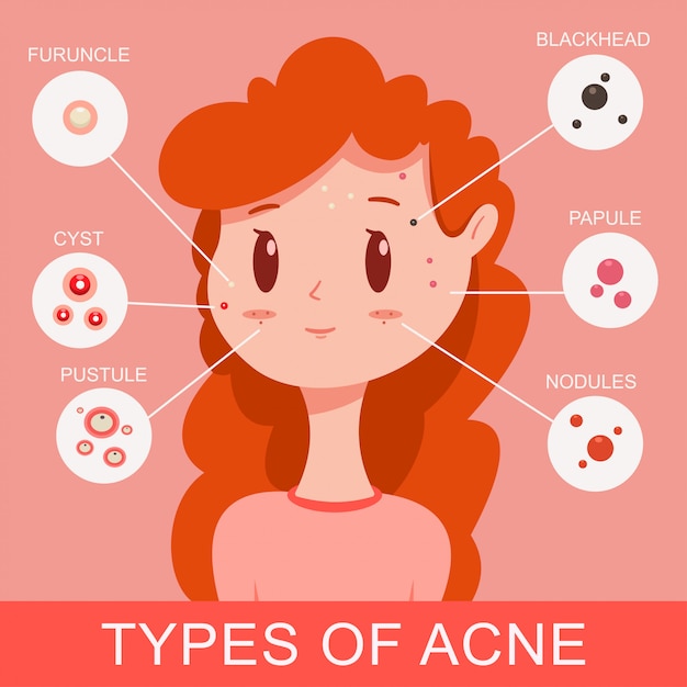 Types of acne infographics. Cute young girl with pimples. Vector cartoon flat medical concept illustration.