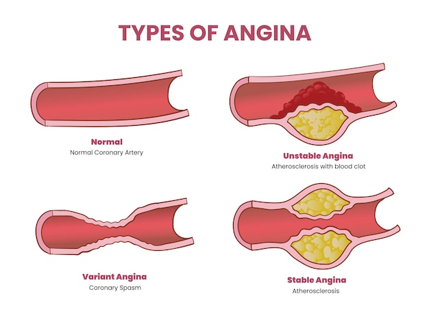 Vector types of angina illustration