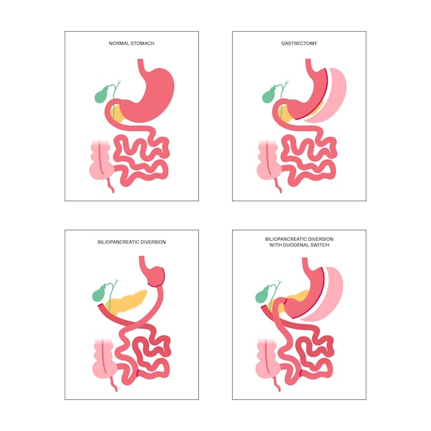 Tipi di chirurgia bariatrica stomaco sano e organi interni dopo l'operazione procedura gastrica per la perdita di peso concetto di laparoscopia addominale problema di sovrappeso e obesità illustrazione vettoriale piatta