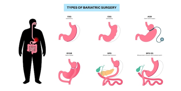 Tipi di chirurgia bariatrica stomaco sano e organi interni dopo l'operazione perdita di peso procedura gastrica concetto di laparoscopia addominale problema di sovrappeso e obesità illustrazione vettoriale piatta