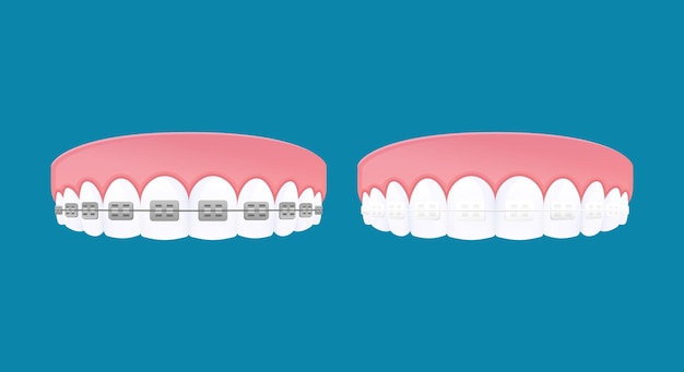 types of braces system. metal and clear brackets teeth.