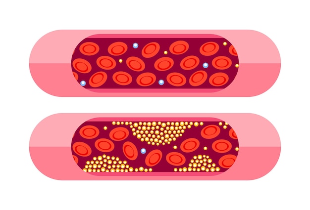 Vector types of cholesterol hdl and ldl cholesterol types labeled educational normal and narrowed artery