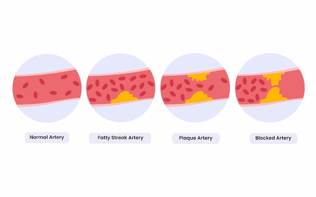 Vector types of cholesterol normal artery, blocked artery, fatty streak, plaque artery health and medical
