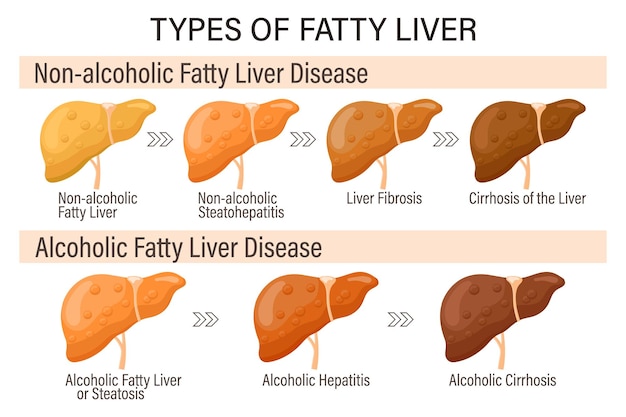 Vector types of fatty liver human liver diseases alcoholic and nonalcoholic fatty liver hepatitis