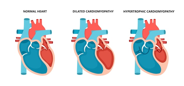 Vector types of heart diseases normal hypertrophic and dilated cardiomyopathy human heart muscle disease