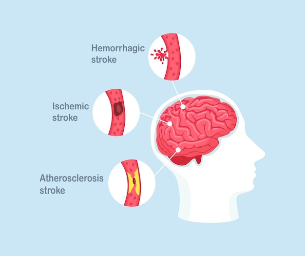 Types of human brain stroke. Ischemic, atherosclerosis and hemorrhagic stroke disease