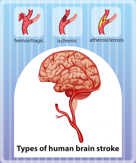 Types of human brain stroke