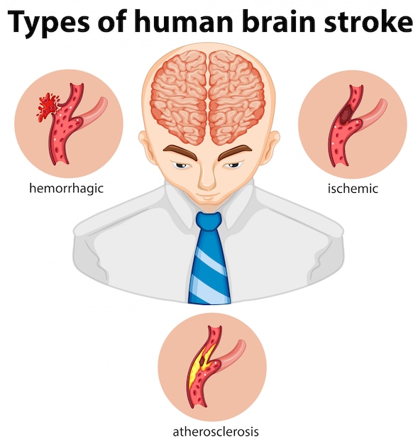 Types of human brian stroke