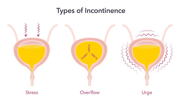 Types of Incontinence medical health vector illustration