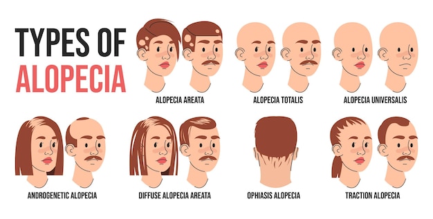 ベクトル 脱毛症の種類 インフォグラフィックベクトル分離 脱毛症に苦しむ人々のイラスト 脱毛症アレアタトータリスとユニバーサリス アンドロゲネティックとトラクション脱毛症