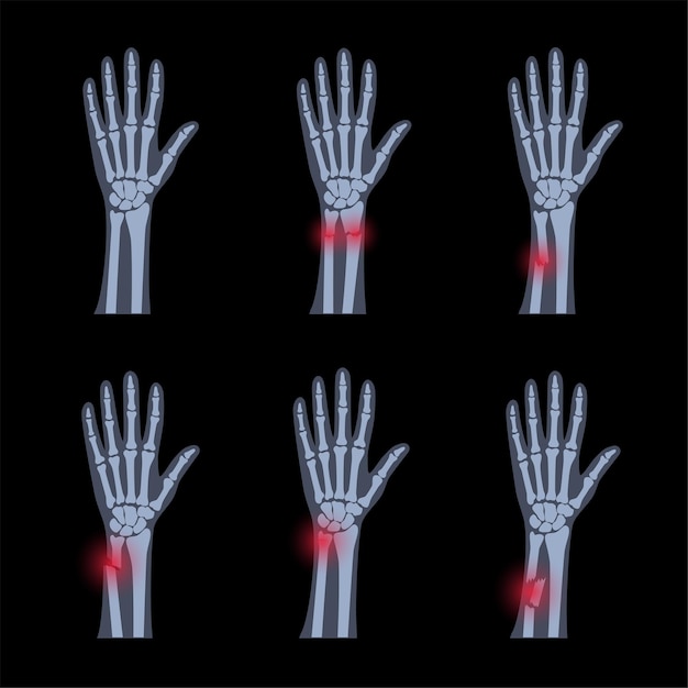 Типы переломов и нормальной руки. внутренняя закрытая и открытая травма. зеленая палочка, дистальная и дробленая