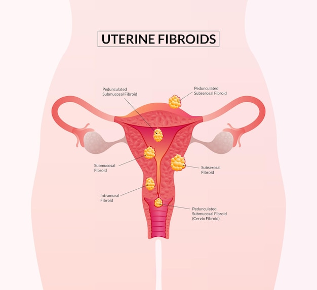 Vector types of uterine fibroids female reproductive system diseases