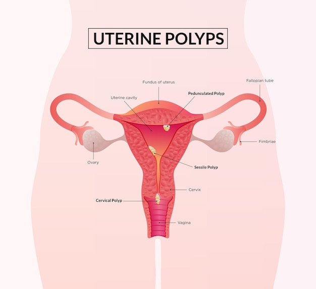 Vector types of uterine polyp female reproductive system diseases