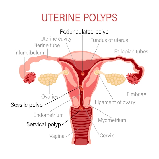 Types of uterine polyps. Diseases of the female reproductive system. Gynecology. Medical concept.