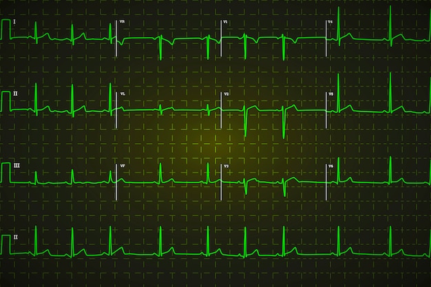 Typical human electrocardiogram, bright green graph on dark background