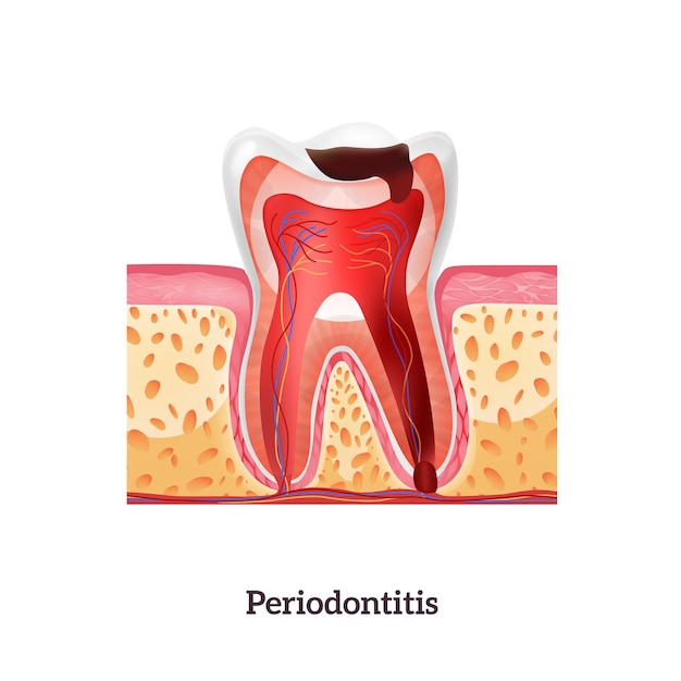 Vector unhealthy tooth with periodontitis