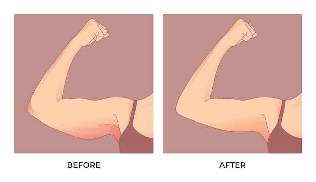 Vector upper arm fat before and after  brachioplasty, liposuction or plastic surgery, woman body shape tran