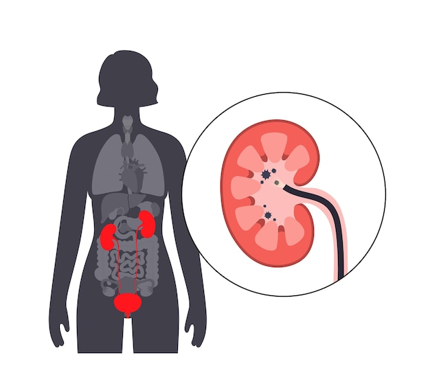 요관경 검사는 최소 침습적 절차입니다. 신장 검사 및 치료 요로 질환 암 폴립 돌 또는 염증 요로 의료 벡터 포스터