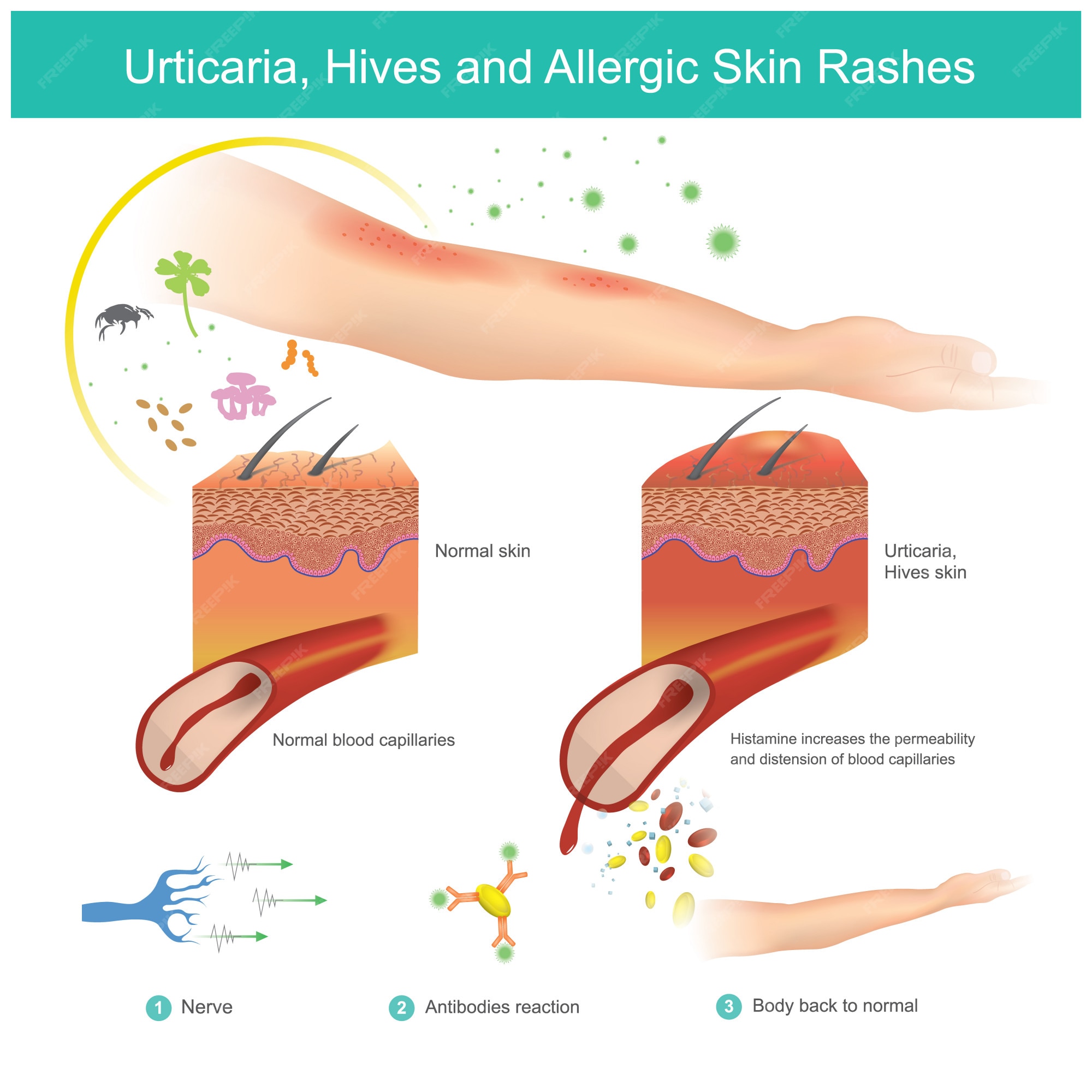 Histamine Reaction On Skin histamine-reaction-on-skin