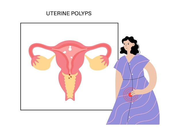 Uterus polyps