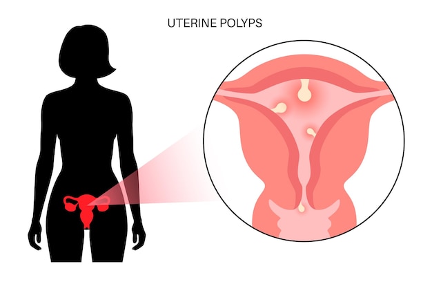 Uterus Polyps