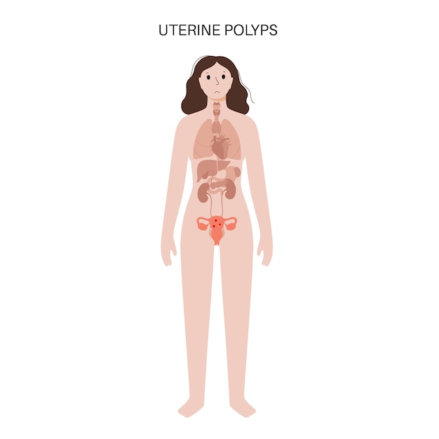 Uterus Polyps