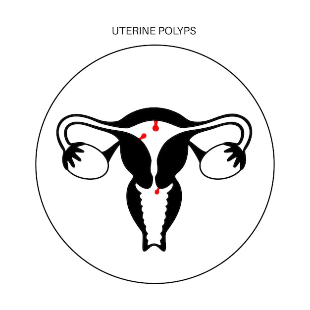 Vector uterus polyps