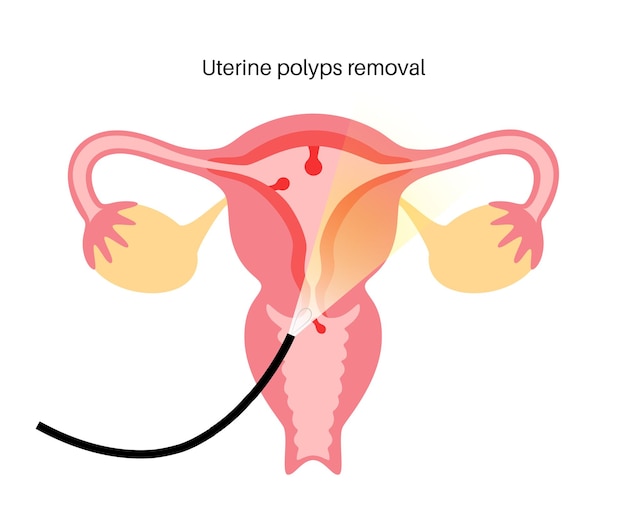 Vector uterus polyps