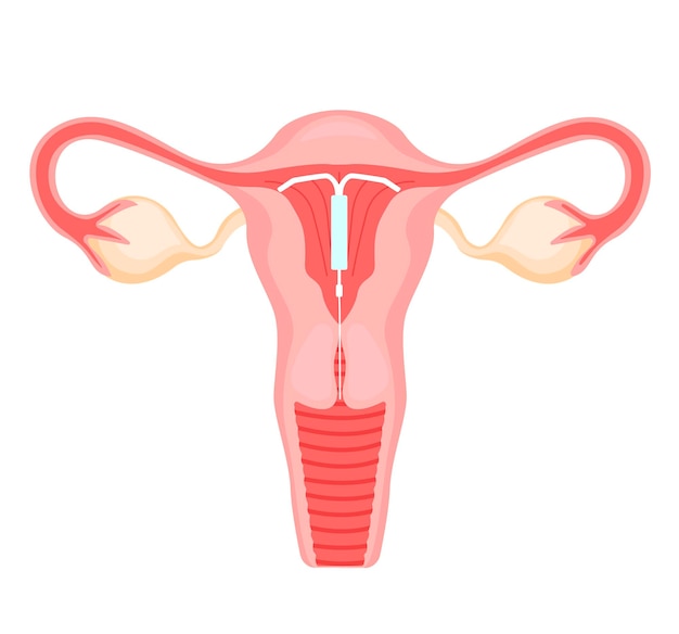 uterus with intrauterine spiral illustration