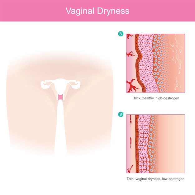Secchezza vaginale. gli strati di tessuto vaginale si assottigliano e seccano quando si riduce il volume dell'ormone estrogeno. sanità e medicina dell'illustrazione.
