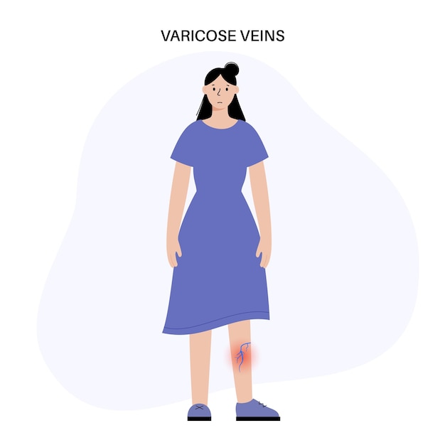 Varicose veins treatment