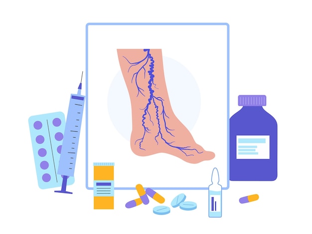 Vettore trattamento delle vene varicose