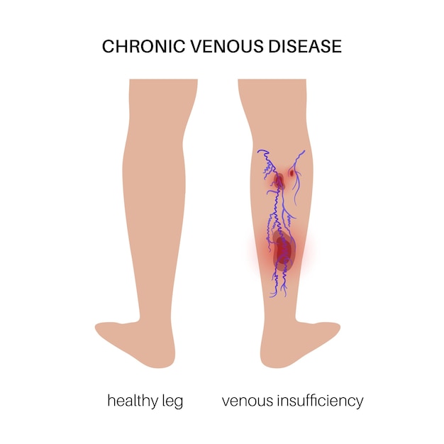 Vector varicose veins treatment