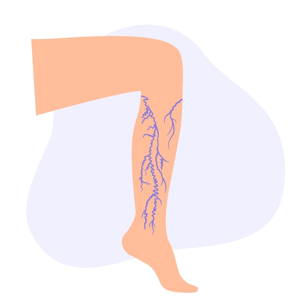 Vector varicose veins treatment