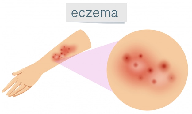 Un vettore di eczema sulla pelle