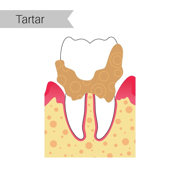 ベクトル 歯石、石灰化した歯垢、歯石のベクトルフラット孤立イラスト。歯の解剖学