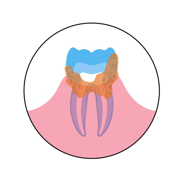 치과 미적분학, 석회화된 플라크, 치석의 벡터 평면 격리된 그림입니다. 치아 해부학