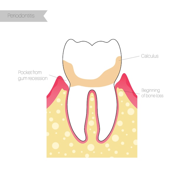 Vector vector flat isolated illustration of periodontitis. tooth anatomy infographics