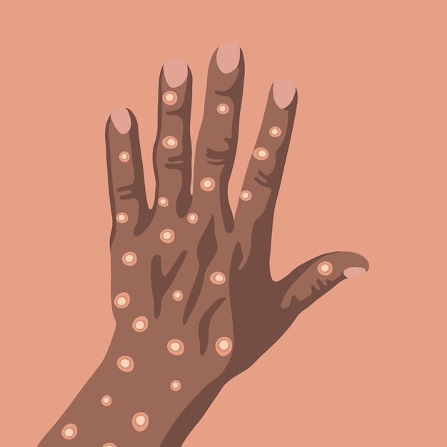 Vector geïsoleerde illustratie van een hand van een zwarte man met apenpokken.