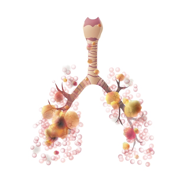 Vector geïsoleerde illustratie van longanatomie met kankertumor. pictogram van het menselijke ademhalingssysteem. gezondheidszorg medisch centrum, chirurgie, ziekenhuis, kliniek logo. interne donororgaan symbool poster