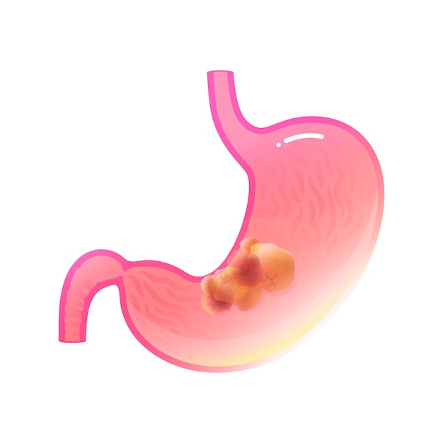 Vector geïsoleerde illustratie van maaganatomie met kankertumor. Chirurgie van het menselijke spijsverteringsstelsel