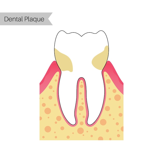 Vector geïsoleerde illustratie van tandplak met ontsteking. Tand anatomie infographics.